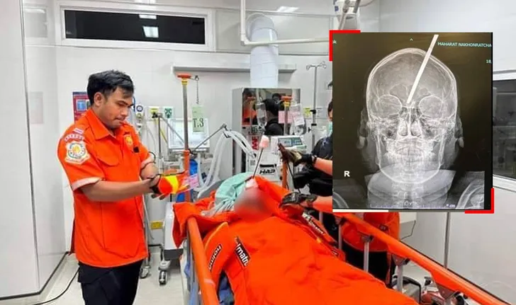 抓魚魚叉反彈刺入大腦 少年痛苦呼救