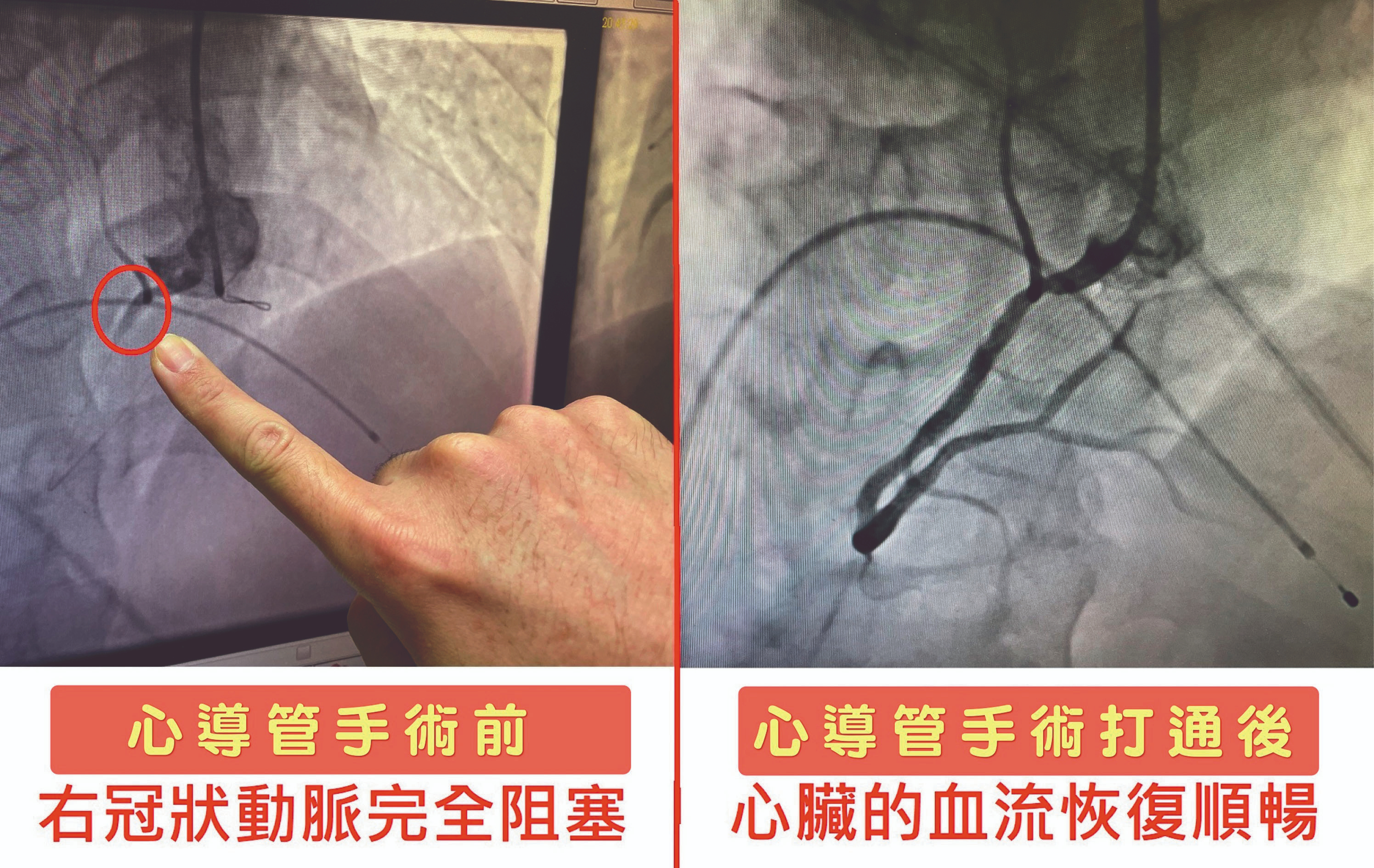 壯男爬山 心肌梗塞險死