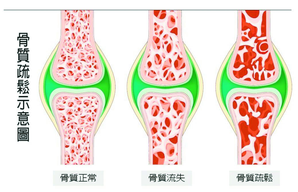 骨鬆 手術僅能緩解疼痛 藥物治療 留意2大副作用