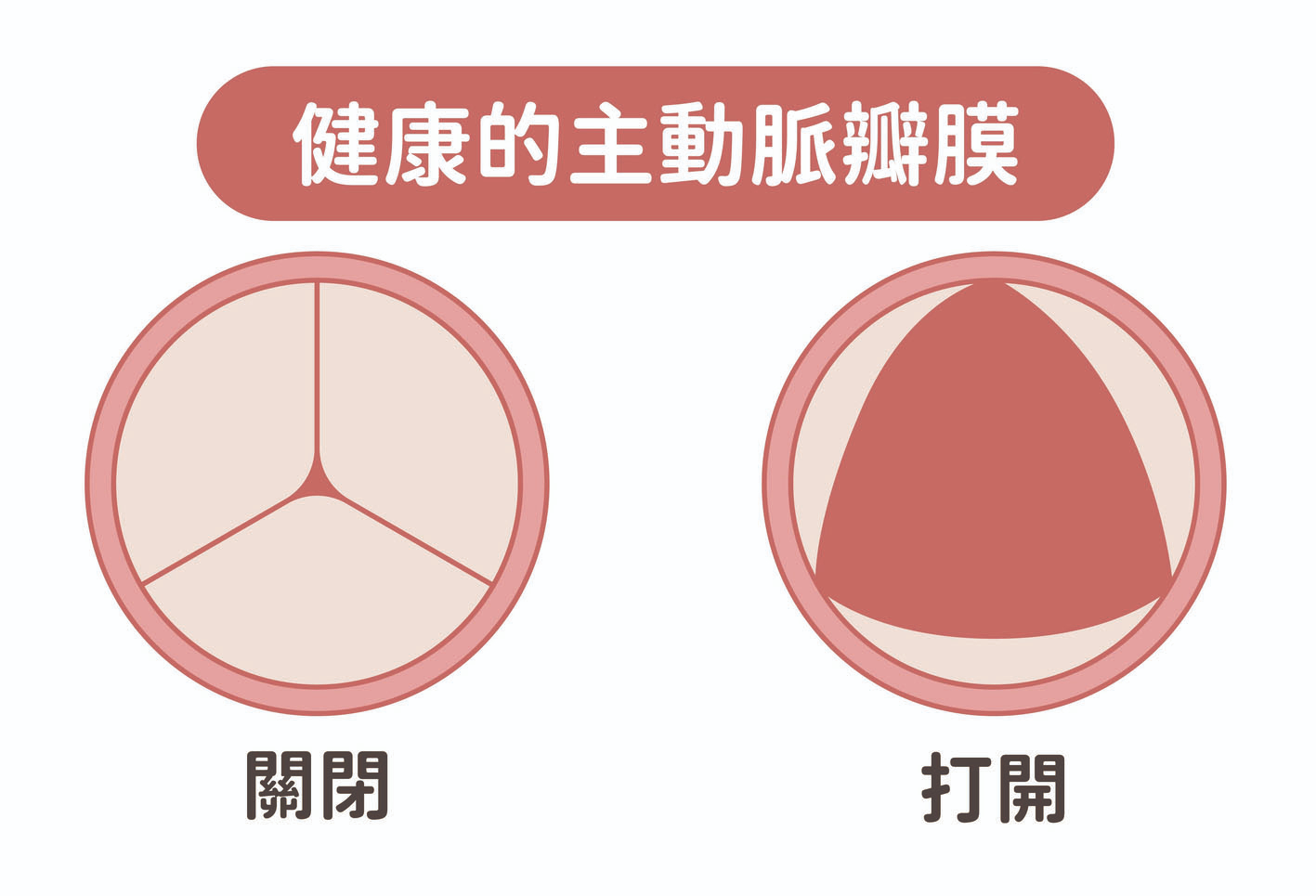 聽心音 揪出瓣膜性心臟病 經導管主動脈瓣膜置換術 不需開胸開心 傷口小、復原快