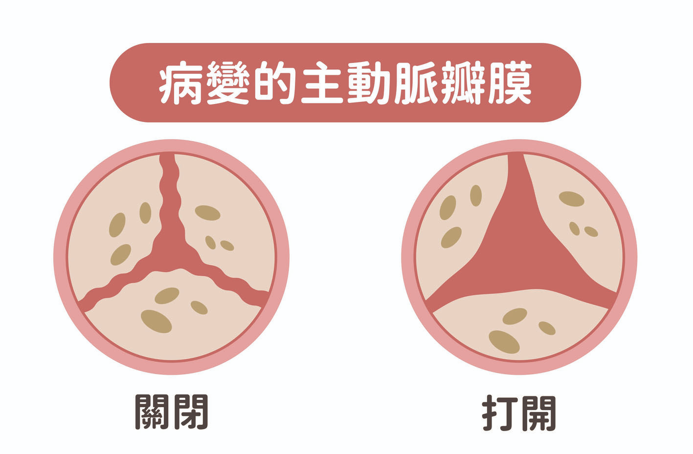 聽心音 揪出瓣膜性心臟病 經導管主動脈瓣膜置換術 不需開胸開心 傷口小、復原快