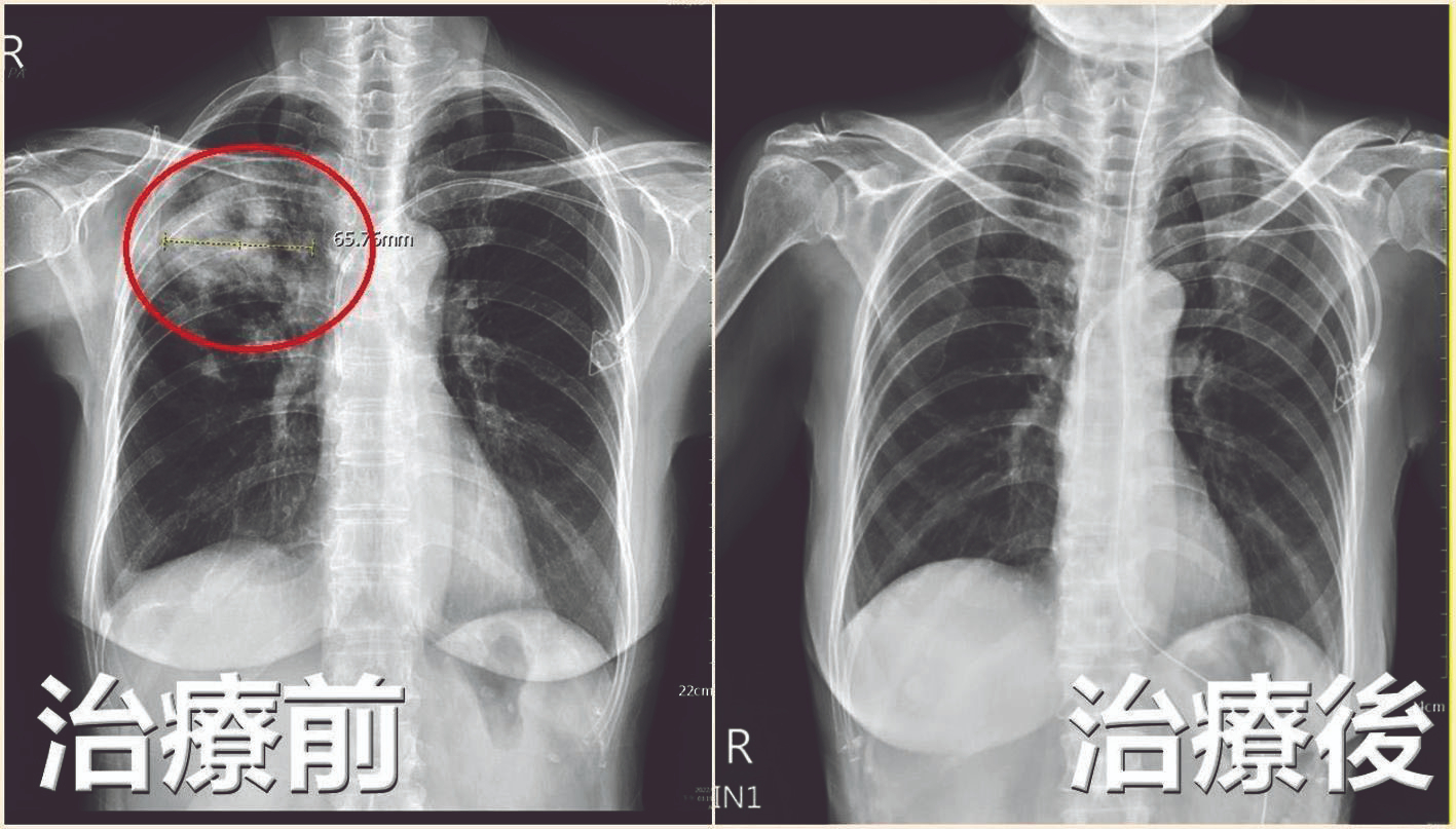 喘咳誤當感冒 竟是隱球菌侵肺