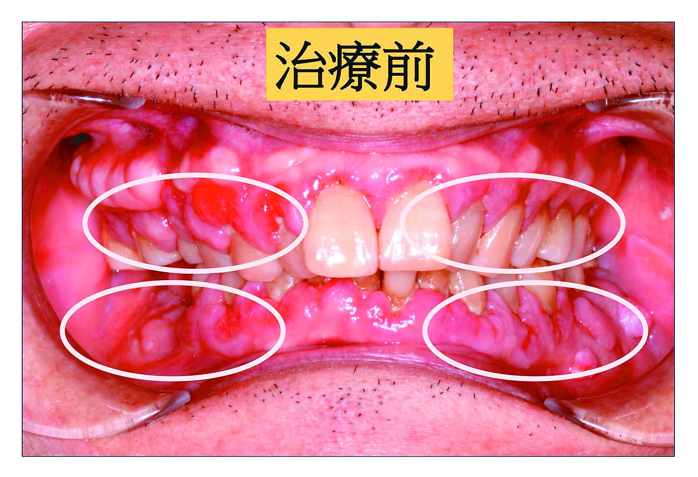 牙齦腫誤當癌 牙周病作祟