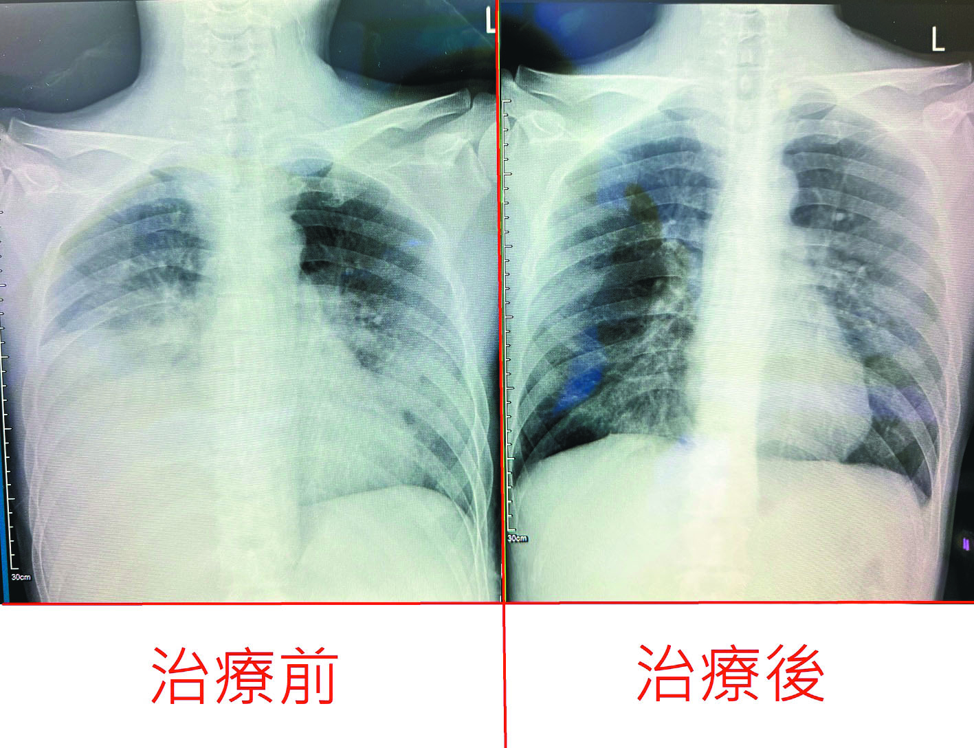 他新冠重症難麻醉 痛忍插管7天
