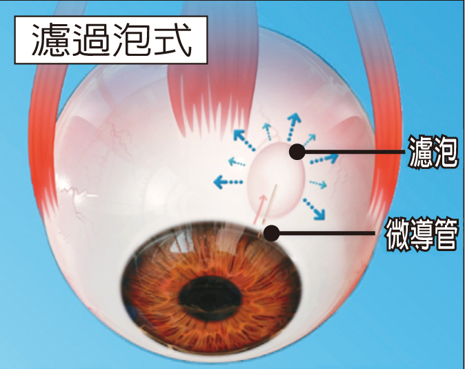 青光眼微創手術 早期新選擇