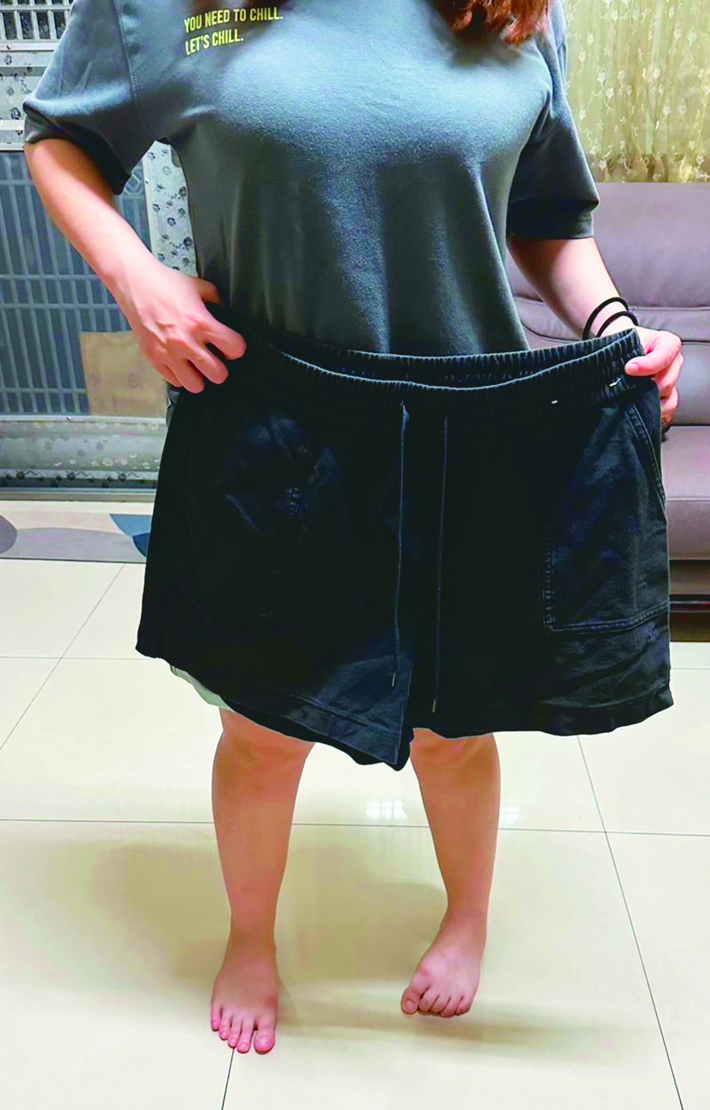 內視鏡減重免開刀 1天就出院