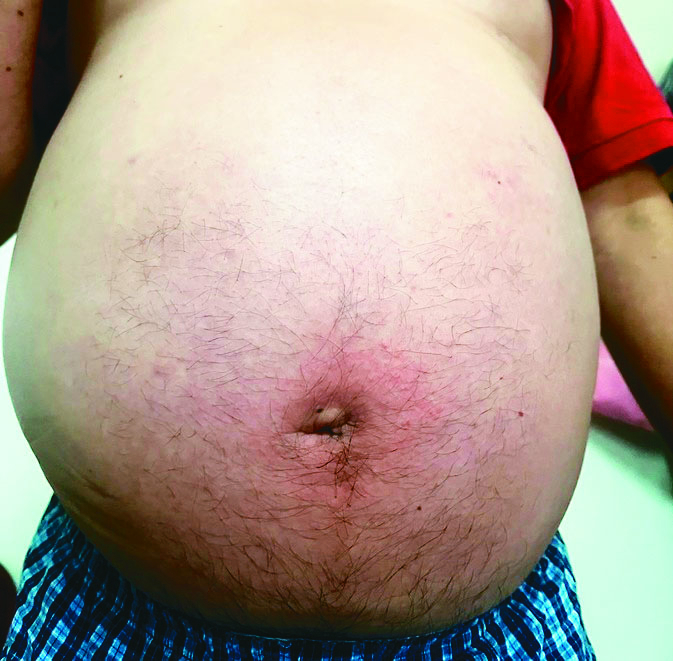 中年男肚大如懷3胞胎 是心衰竭