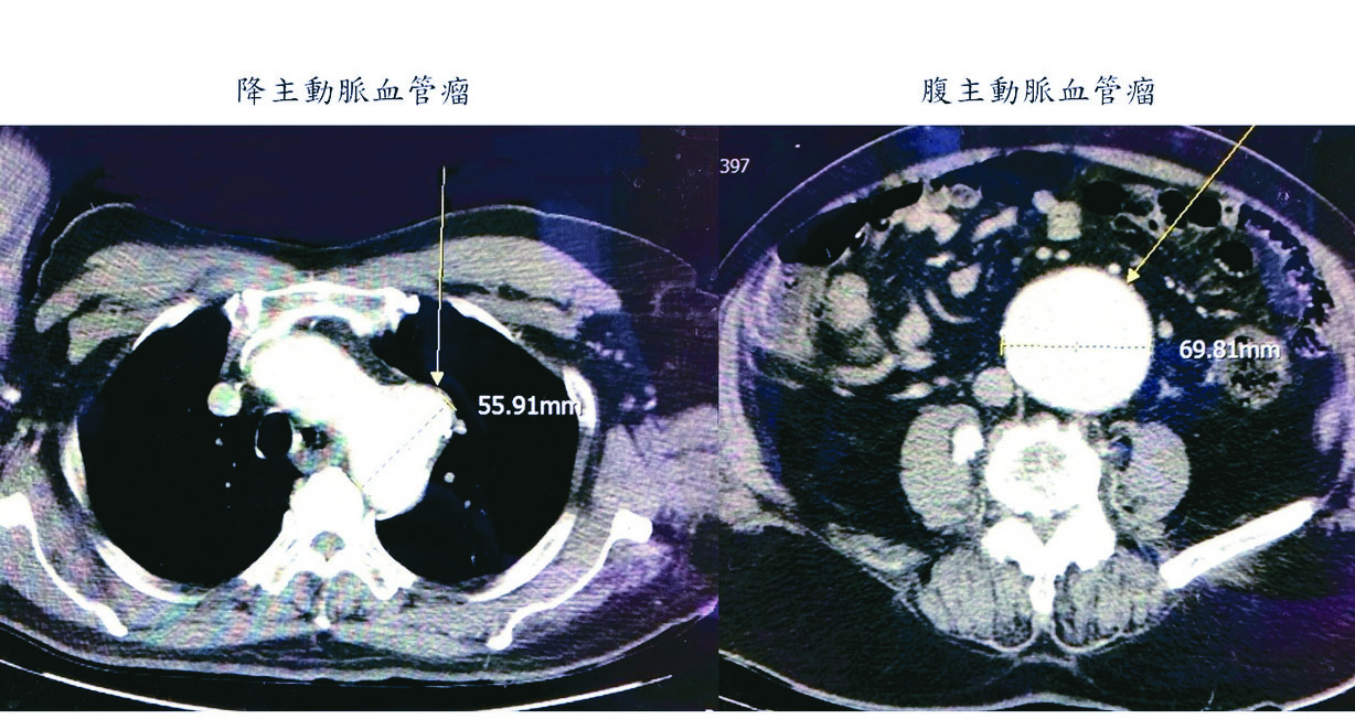 2顆大血管瘤 翁痛昏險送命
