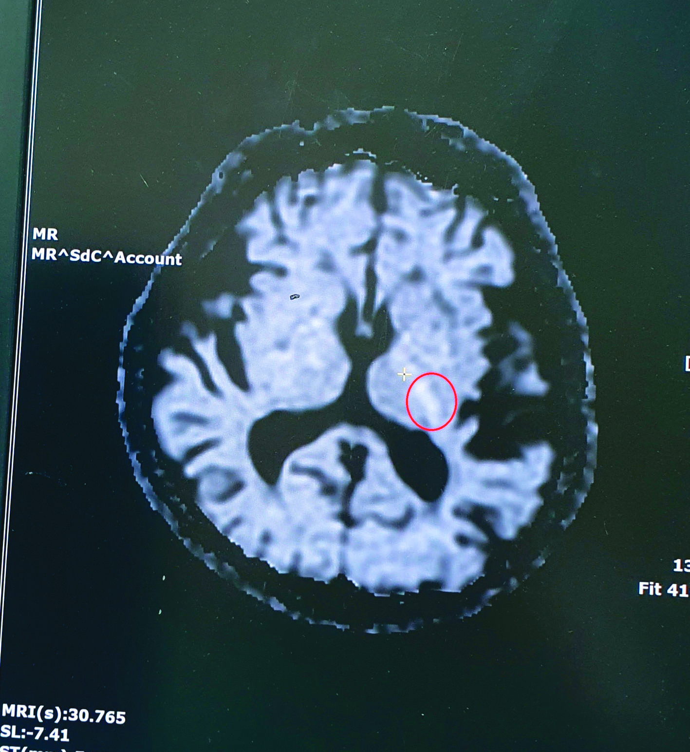 男右腳無力以為腰傷 診出小中風