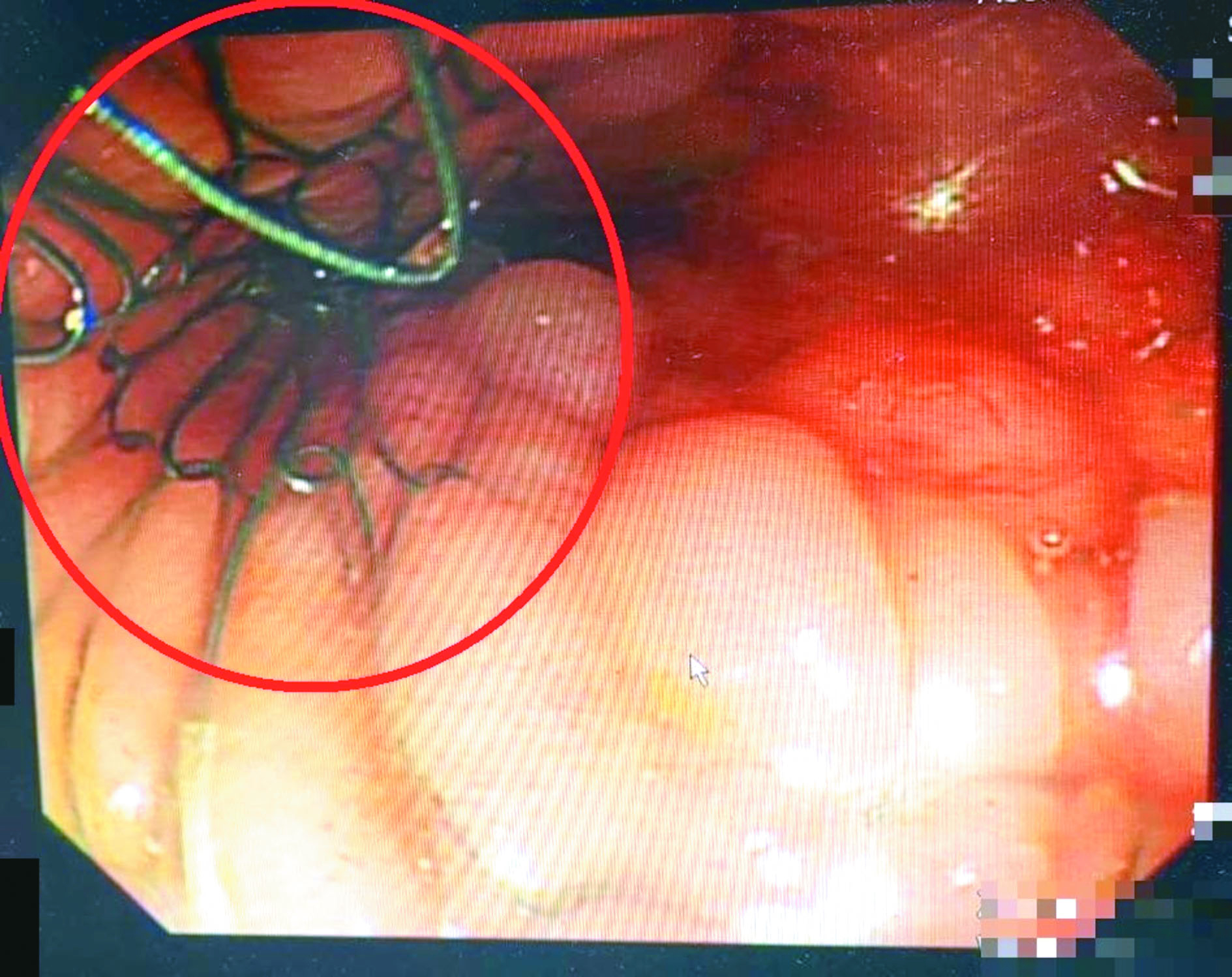 卵巢癌導致腸阻塞 老婦腹脹如球大腸支架助消氣